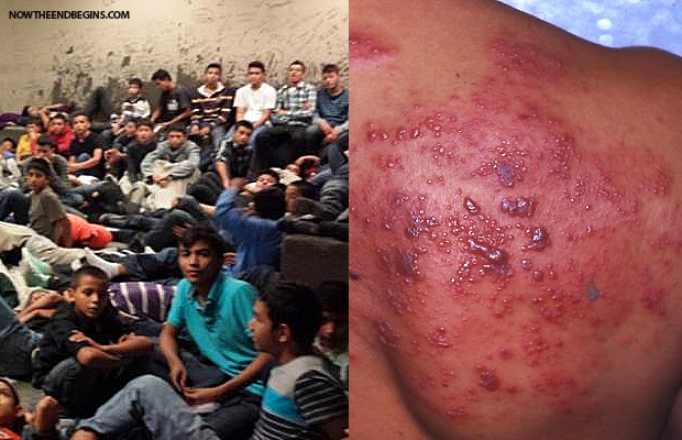obama-letting-in-illegal-aliens-with-scabies-other-diseases